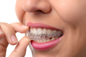 invisalign treatment - orthodontics